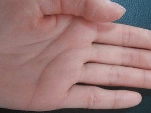 手足癣症状特点有什么