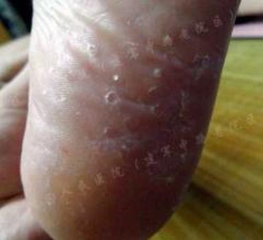 预防手足癣有效的方法