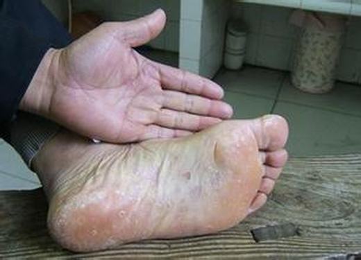足癣出现后通常应该如何护理