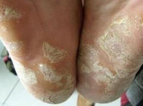 手足癣的病因症状是什么