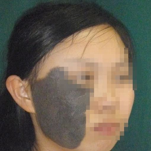 遗传性太田痣的发病原因