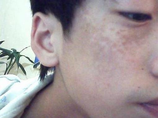 太田痣的术后应该如何护理