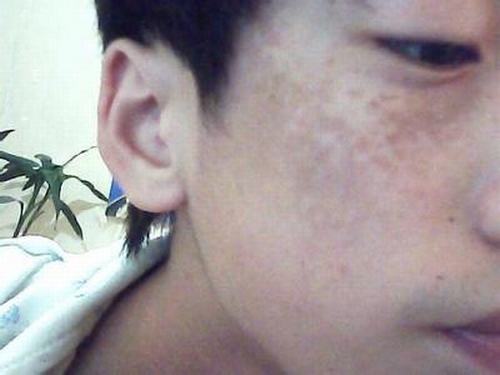 太田痣型皮肤的诊断方法