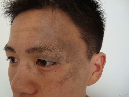 遗传性太田痣的症状
