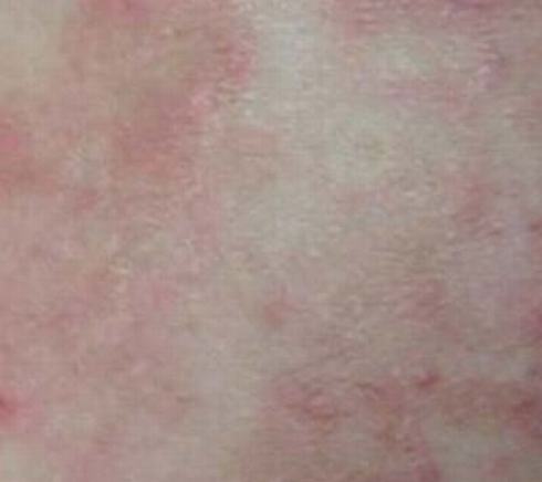 体癣是怎样发生的