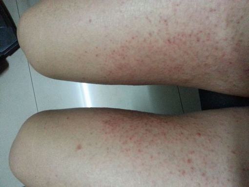 体癣要如何鉴别诊断呢？