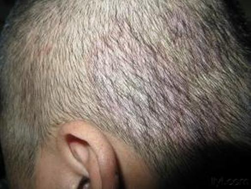 头癣的防治有哪些方法