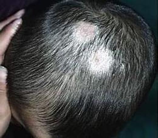 头癣患者早期的症状表现是什么