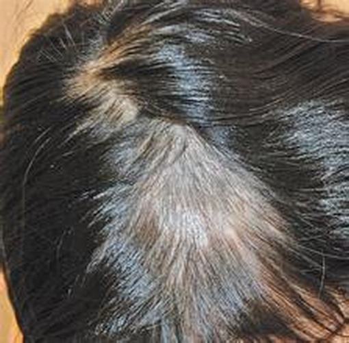 如何预防头癣发生