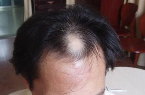 对于脱发的预防方法介绍