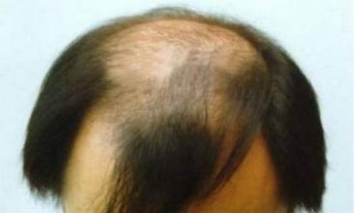 脱发有哪些发病因素