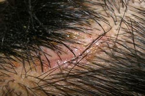脱发患者在治疗过程需要注意些什么