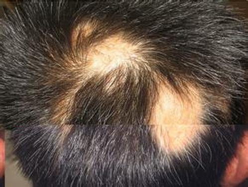 脱发患者在平常生活中需有哪些要注意细节