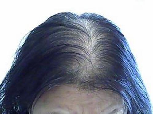 脱发患者日常要求有哪些要注意