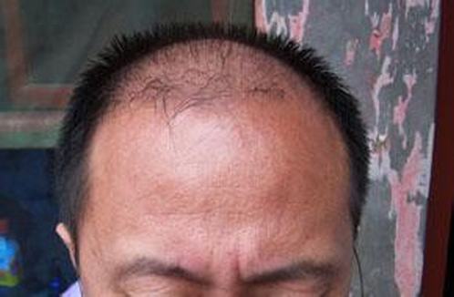 脱发患者日常护理措施