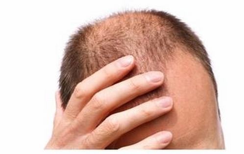 脱发患者的烦恼和伤害有什么