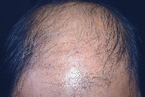 脱发都是什么病因引发