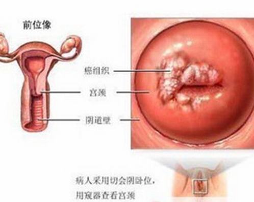 外阴白斑其他女性白斑病的区别是什么