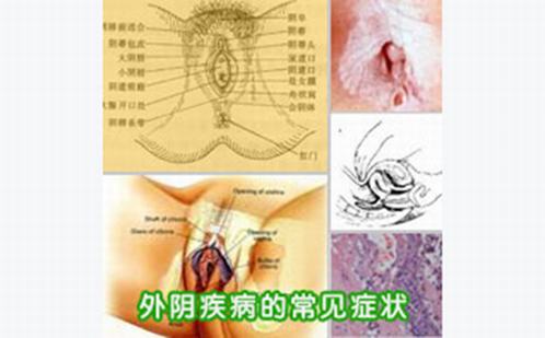 外阴白斑的辅助检查有哪些呢