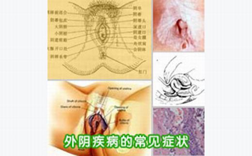 外阴白斑疾病的具体症状形态是什么？