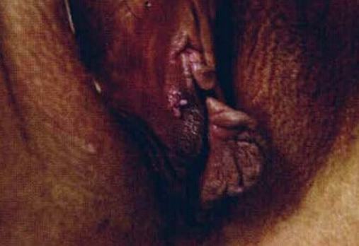 性病疑病性神经病高发人群