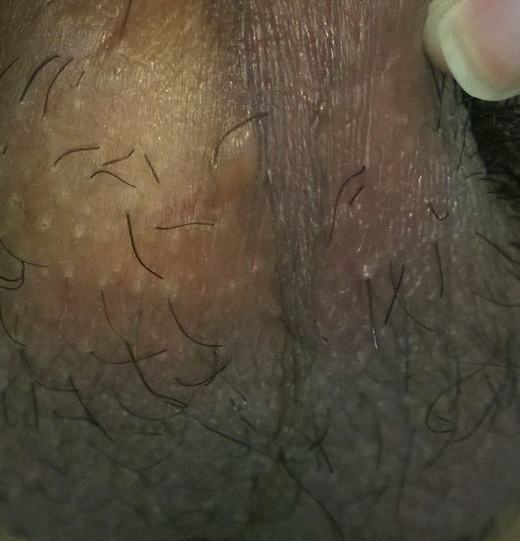 如何预防治疗混合性性病感染