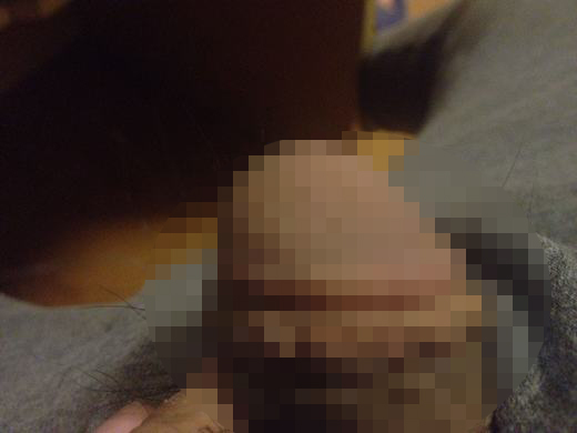 性病患者支原体感染情况严重