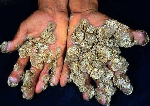 扁平疣不同于寻常疣的特别之处