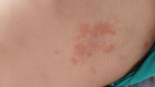 胆碱能性荨麻疹有哪些表现