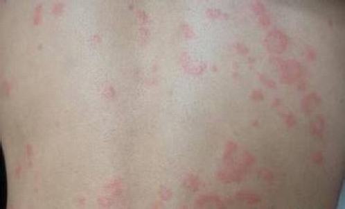 引发荨麻疹的几大因素是什么