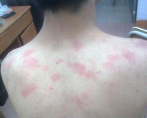接触型荨麻疹如何防止