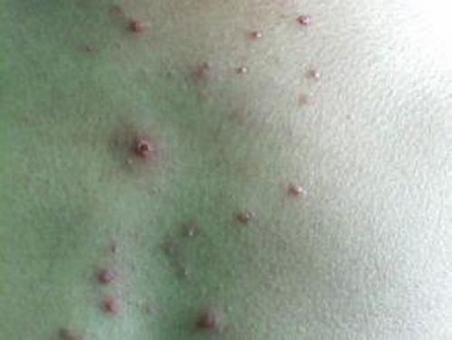 荨麻疹早期症状有什么