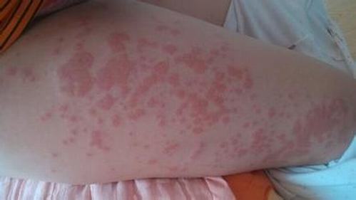 荨麻疹在什么季节比较容易犯病？