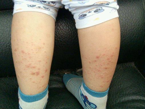 儿童发生药疹会有哪些症状