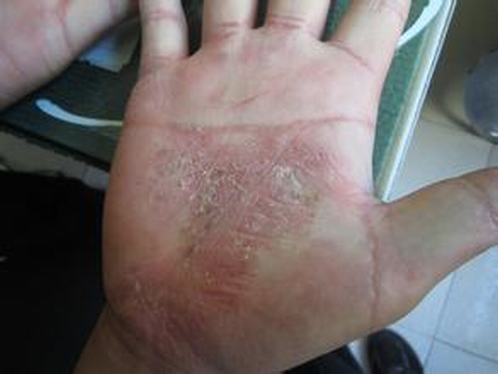 银屑病患者常属哪一种性格