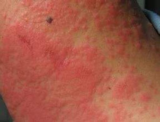 亚急性湿疹是什么症状表现