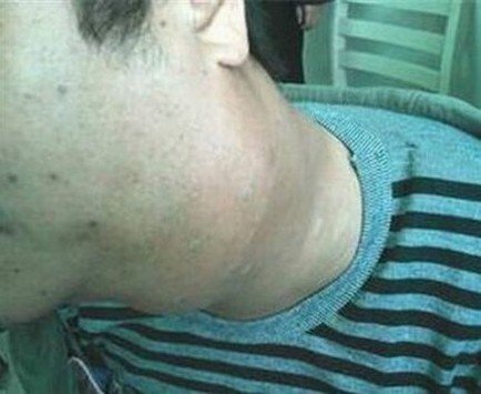 艾滋病的初期病情有哪些 3大疾病征兆需警惕