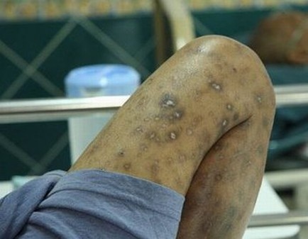艾滋病的传播途径一般有什么