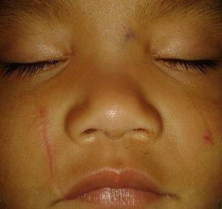 脸上痤疮引起的疤痕增生,如何治疗-