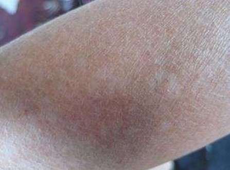 白斑患者饮食这一方面面要有什么样的事项要注意