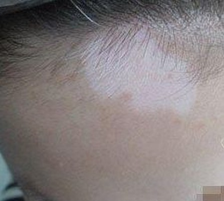 白斑会出现什么症状呢