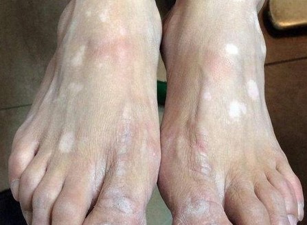 白斑面积扩散变大是什么情况