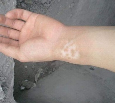 白斑所导致的并发症