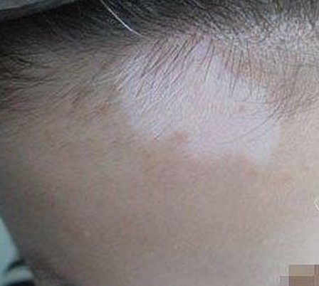 白斑有什么样的症状