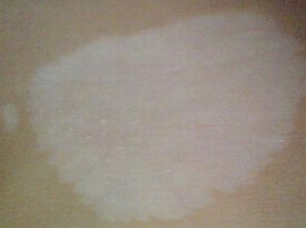 白斑病的治疗