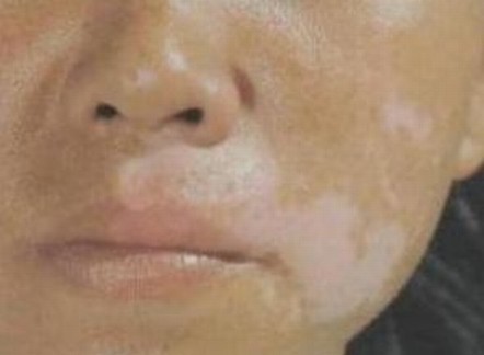 白斑病患者出现治疗恢复慢的原因是什么