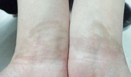 白斑病容易引发哪些并发症
