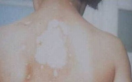 白斑出现于颈部会给患者造成哪些伤害