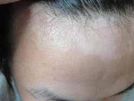 白斑初期病情