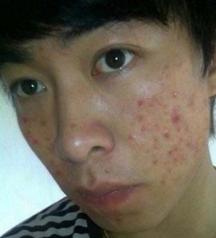 痤疮的药物治疗办法有什么呢
